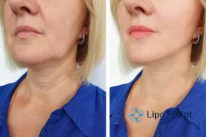 Double chin before and after Hi-Fu treatment 4 Book your double chin treatment Bradford on Avon today! We are here to help!