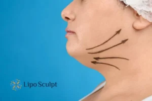 Double chin before and after Hi-Fu treatment 3 Boost your confidence with a Double chin treatment Bradford on Avon