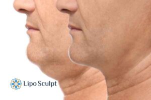 Double chin before and after Hi-Fu treatment 2 Double chin treatment Bradford on Avon from Lipo Sculpt - feel more confident today!