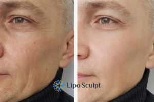 How to Fight Aging Symptoms 3 Fight Aging Symptoms Bradford on Avon With HIFU and Morpheus8 Today!