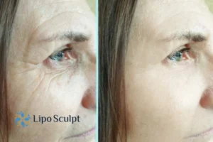 How to Fight Aging Symptoms 2 Do you want to Fight Aging Symptoms Bradford on Avon? Contact Lipo Sculpt today!