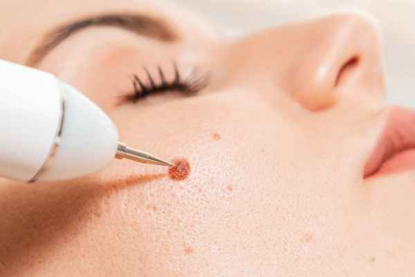 CryoPen: 5 Skin Concerns It May Be Used to Treat 3 What actually happens during a CryoPen treatment Bradford on Avon?