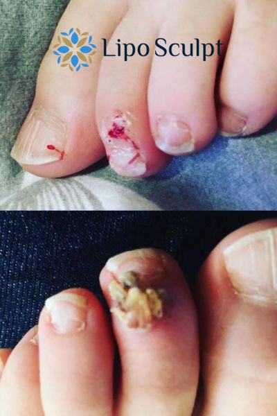 Wart removal customer results from Lipo Sculpt Bradford on Avon
