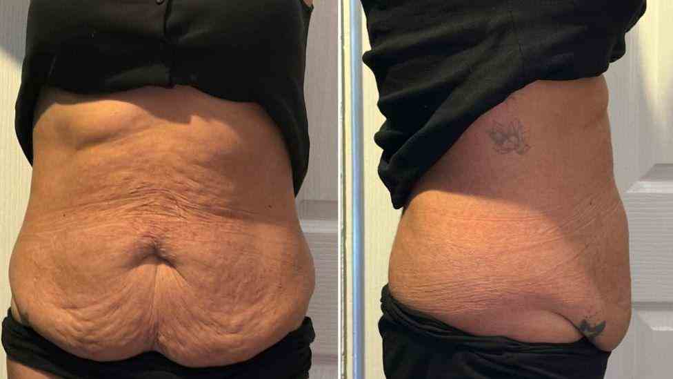 Lost the Weight but Not the Loose Skin? What You Should Know 1 Is It Definitely Loose Skin Bradford on Avon?
